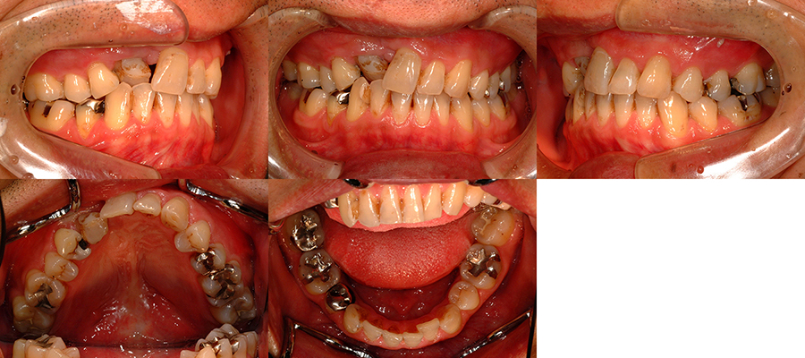 口唇口蓋裂の矯正治療例一覧 | 口唇口蓋裂 | 広島中央矯正歯科