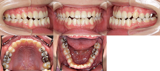 顔面非対称 | 不正咬合の種類 | 不正咬合の治療方法 | 広島中央矯正歯科